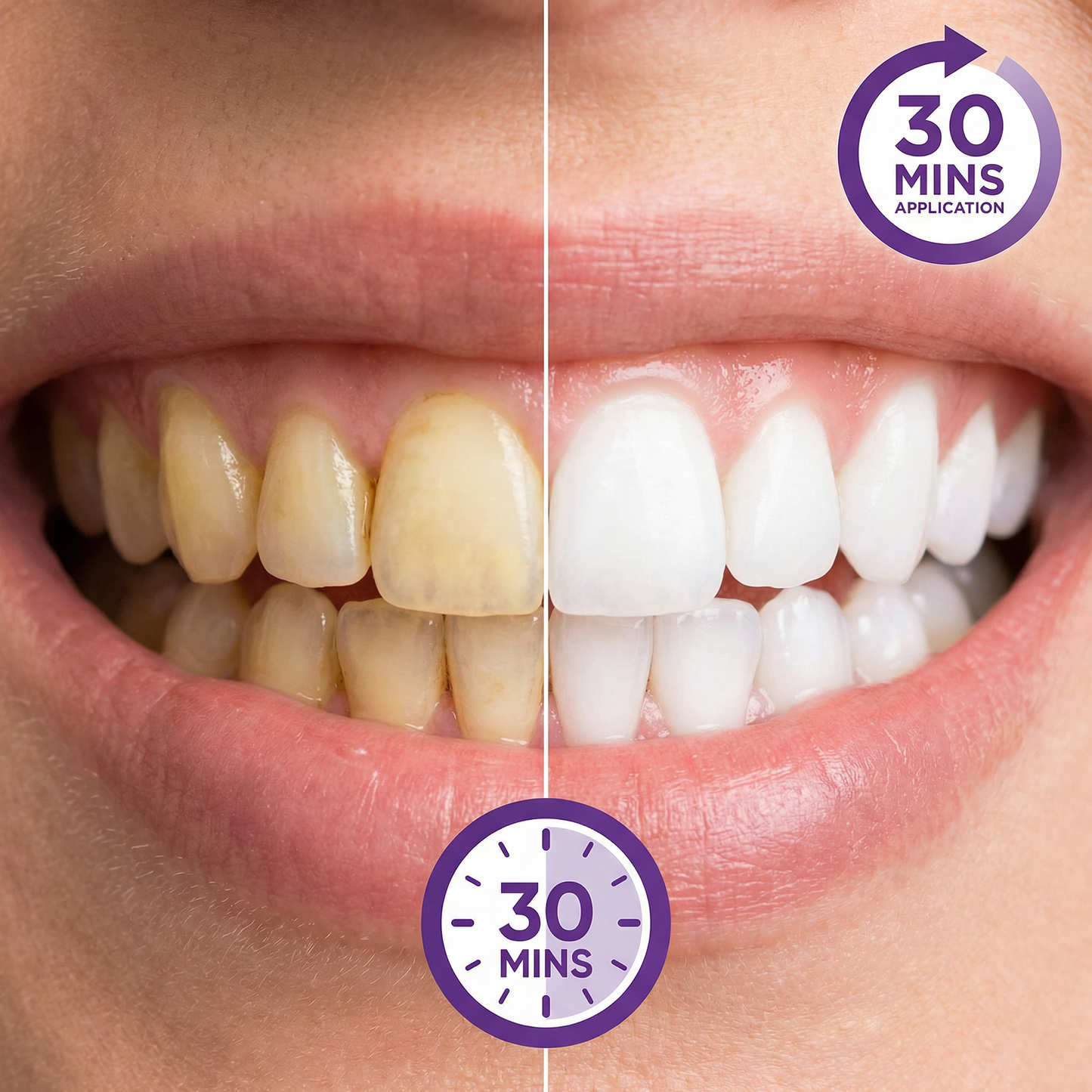 Purple Whitening Strips